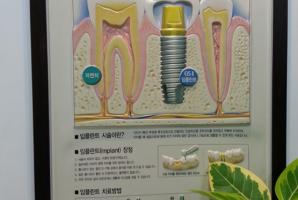 [진료정보/안내제작] 병원/치과/소아과 안내판 치과-임플란트정보